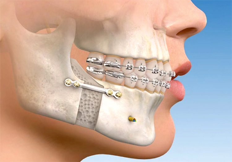 Cirurgia ortognática: restaura a harmonia facial e função mastigatória | Taguatinga